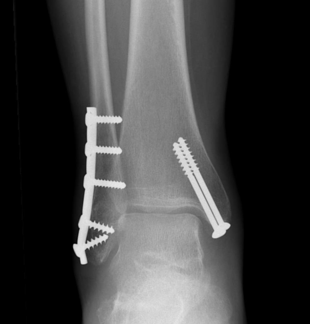 Ankle Fracture Bimalleolar ORIF